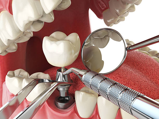 Best Lost Filling or Crown Replacement in Tappan, NY